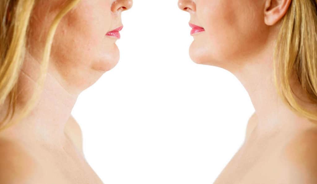 Double Chin treatment Woking before and after results