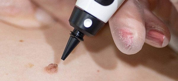 After Skin Tag Removal Woking