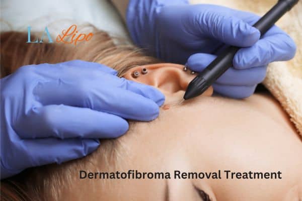 Dermatofibroma Removal Treatment Woking