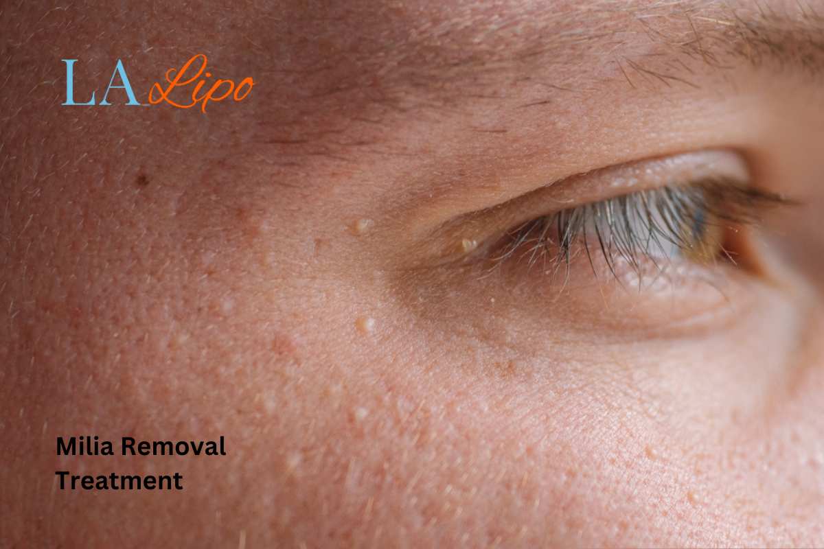 Cryopen Milia Removal: Is It the Easiest and Safest Option Woking?