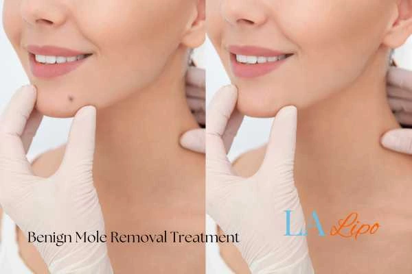 Before-and-after results following benign mole-removal treatment Woking