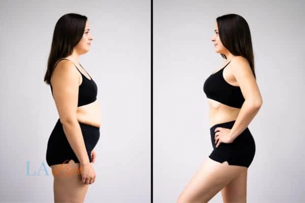 image of woman before and after results of LA-EMS Body Sculpting Woking to help treat Diastasis recti