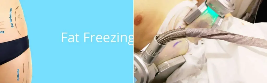 Fat freezing Woking on multiple areas of the body
