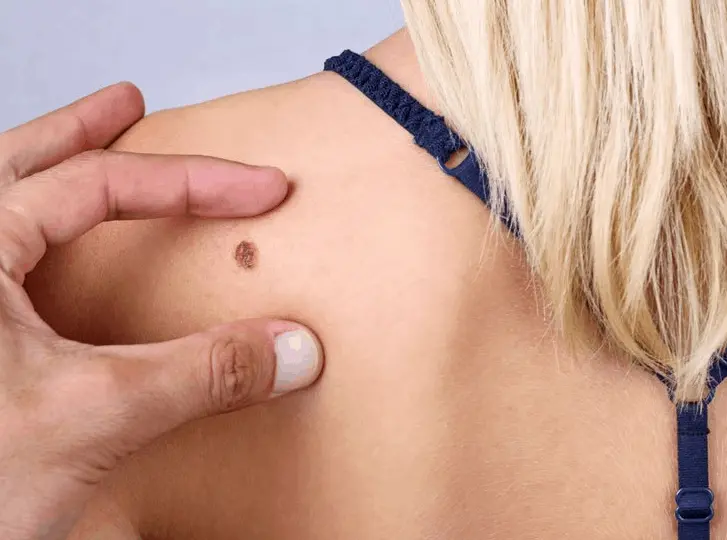 woman having mole removal Woking consultation before treatment.