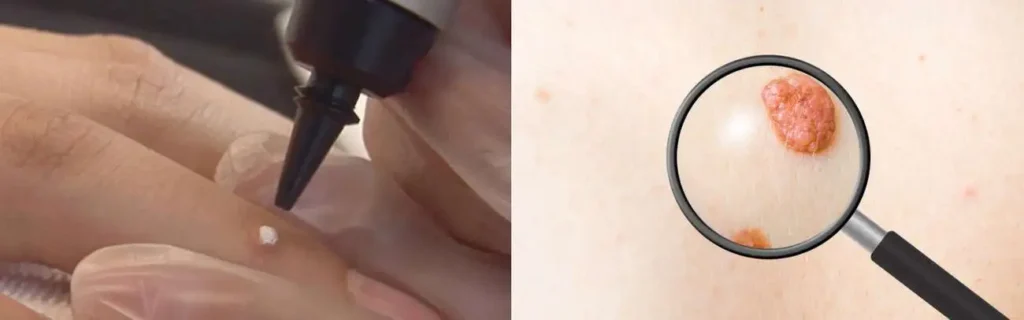 Cryopen for mole removal Woking - speak to our team today!