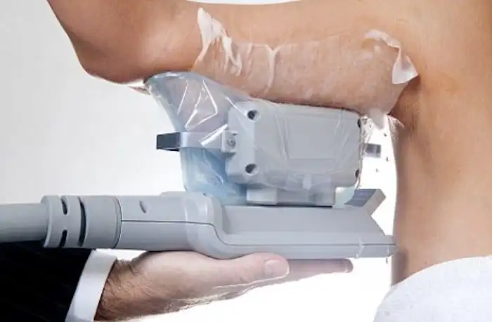 Picture of fat freezing Woking on the upper arms.