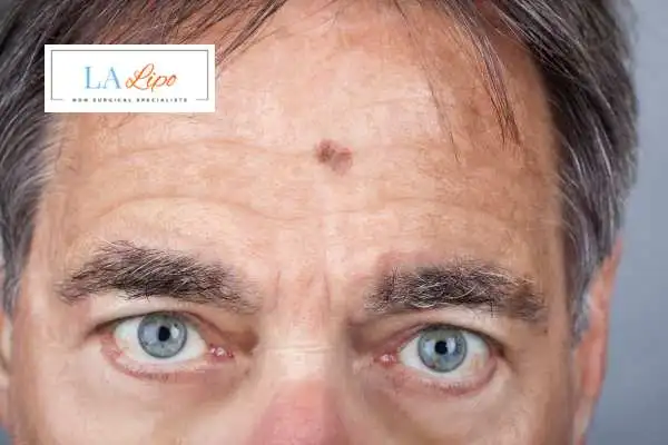 Solar Lentigo Removal Woking image of man with mark on his forehead