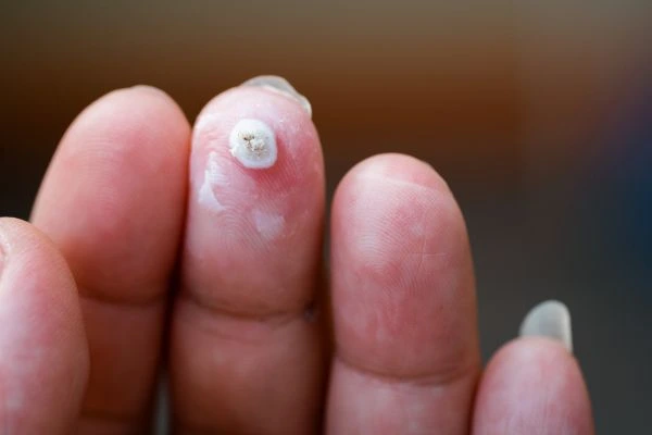wart on person finger - cryotherapy to treat from LA LIPO Woking
