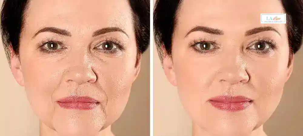 How Long Does It Take to See Results and How Long Do They Last Woking?