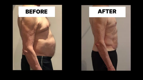 What Symptoms Can Diastasis Recti Cause in Men? Weak Core, Back Pain and Poor Posture Woking